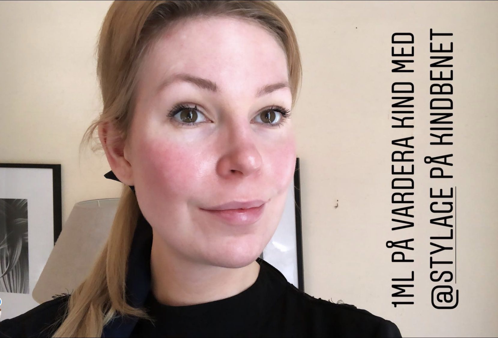 Fylla kindbenen med filler