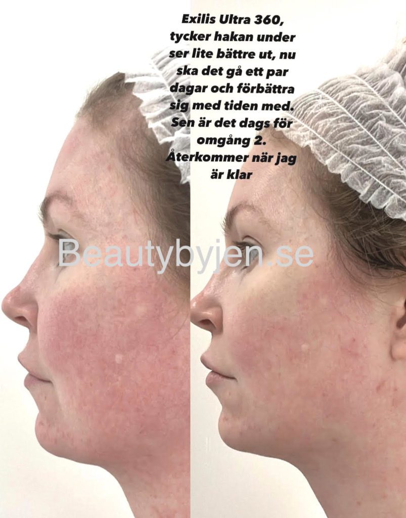 Exilis Ultra 360 ansikte och hals behandling