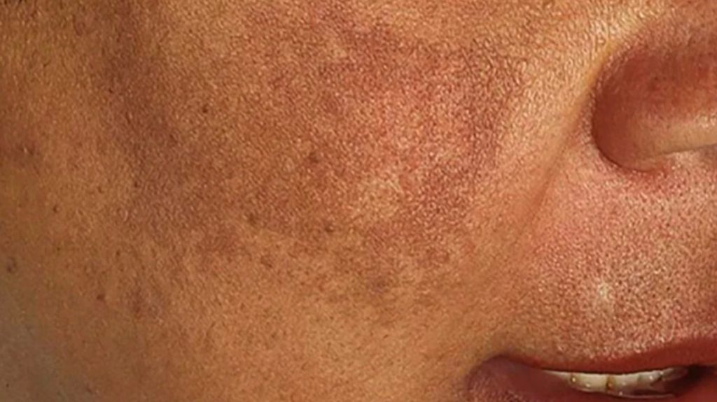 Bästa behandling för att behandla Melasma