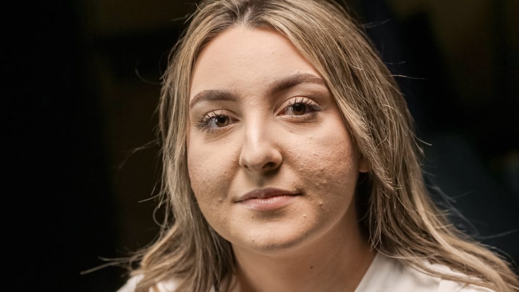 behandla aktiv acne