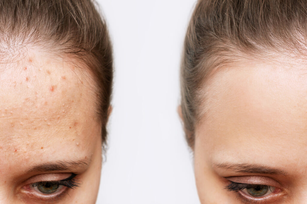 Cropped shot of a young woman's face before and after acne treatment on face. Pimples, red rash on the girl's forehead. Problem skin, allergy, care and beauty concept. Dermatology, cosmetology